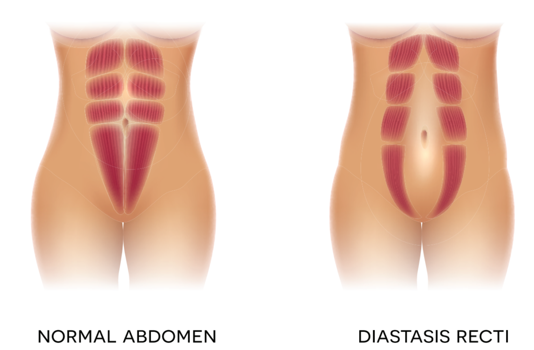 Diastasis Recti - Mind the Gap - Fizzio For Life